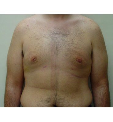 gynecomastio after